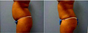 26 Year Old Woman Treated With Tummy Tuck With Doctor Chad Robbins, MD, Nashville Plastic Surgeon