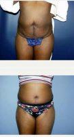26 Year Old Woman Treated With Tummy Tuck With Dr Laura A. Sudarsky, MD, Fort Lauderdale Plastic Surgeon