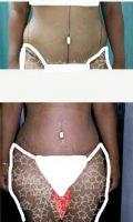 27 Year Old Woman Treated With Tummy Tuck By Dr. Disnalda Matos, MD, Dominican Republic Plastic Surgeon