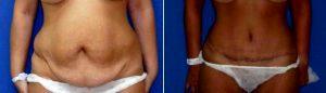 28 Year Old Woman Treated With Tummy Tuck And Liposuction . With Dr. Boaz Aman, MD, Tel Aviv Plastic Surgeon