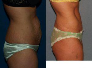 28 Year Old Woman Treated With Tummy Tuck With Dr Gregory M. Fedele, MD, Beachwood Plastic Surgeon