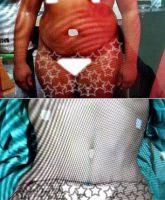 28 Year Old Woman Treated With Tummy Tuck With Dr Tania Medina De Garcia, MD, Dominican Republic Plastic Surgeon