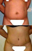 28 Years Old, No Kids Some Abdominal Lipodistrophy With Dr. Cynthia Disla, MD, Dominican Republic Plastic Surgeon