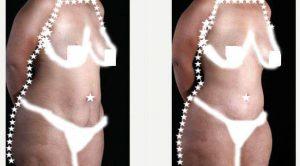 29 Year Old Woman Treated With Tummy Tuck By Doctor Christopher T. Chia, MD, New York Plastic Surgeon
