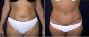 29 Year Old Woman Treated With Tummy Tuck By Doctor Troy Andreasen, MD, Ontario Plastic Surgeon 174