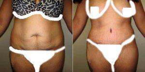 29 Year Old Woman Treated With Tummy Tuck By Dr Thomas C. Wiener, MD, Houston Plastic Surgeon