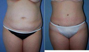 30 Year Old, Lipoabdominoplasty With Dr. Steven Yarinsky, MD, Albany Plastic Surgeon