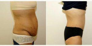 30 Year Old Woman Treated With Tummy Tuck With Doctor Neal Goldberg, MD, Westchester Plastic Surgeon