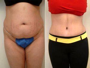 30 Year Old Woman With Loose Tummy After Pregnancy. Before By Dr Franklin D. Richards, MD, Bethesda Plastic Surgeon