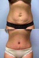 31 Year Old Woman Treated With Tummy Tuck And Liposuction By Dr Amy T. Bandy, DO, FACS, Newport Beach Plastic Surgeon