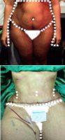 31 Year Old Woman Treated With Tummy Tuck By Dr. Tania Medina De Garcia, MD, Dominican Republic Plastic Surgeon