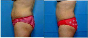 32 Year Old Woman After Tummy Tuck Before With Dr David A. Sieber, MD, San Francisco General Surgeon