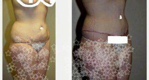 32 Year Old Woman Treated With Tummy Tuck And Liposuction Of Hips By Doctor Jack Peterson, MD, Topeka Plastic Surgeon