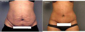 32 Year Old Woman Treated With Tummy Tuck By Doctor Michael Zwicklbauer, MD, Newport News Plastic Surgeon