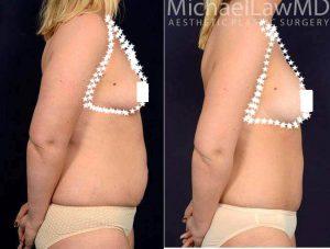 32 Year Old Woman Treated With Tummy Tuck By Dr Michael Law, MD, Raleigh-Durham Plastic Surgeon