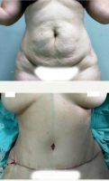 32 Year Old Woman Treated With Tummy Tuck With Doctor Jean Paul Giudicelli Saba, MD, Dominican Republic Plastic Surgeon