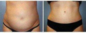 32 Year Old Woman Treated With Tummy Tuck With Dr Brian K. Reedy, MD, Reading Plastic Surgeon