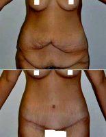 32 Year Old Woman Treated With Weight Loss With Doctor Max Gouverne, MD, Corpus Christi Plastic Surgeon