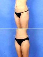 33 Year Old Female Tummy Tuck With Lipo With Dr Aldo Guerra, MD, Scottsdale Plastic Surgeon