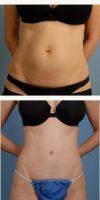 33 Year Old Woman Treated With Tummy Tuck By Dr. Kouros Azar, MD, Thousand Oaks Plastic Surgeon