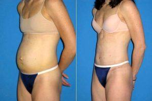 34 Year Old Female Abdominal Skin Excess And Rectus Diastasis By Doctor Alyson Wells, MD, FACS, Baltimore Plastic Surgeon