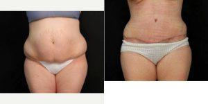 34 Year Old Female With Abominoplasty (tummy Tuck) And Liposuction Of Hips With Dr. Lawrence Scott Ennis, MD, FACS, Pensacola Plastic Surgeon