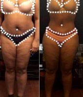 34 Year Old Woman Treated With Tummy Tuck With Dr. Disnalda Matos, MD, Dominican Republic Plastic Surgeon