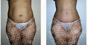 34 Year Old Woman Treated With Tummy Tuck With Dr. Jose Hungria, MD, Dominican Republic Plastic Surgeon