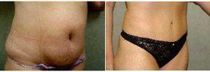 34 Year Old Woman Treated With Tummy Tuck With Dr. Robert H. Schnarrs, MD, Norfolk Plastic Surgeon