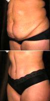 35 Year Old Female Had Her Abdomen And Flanks Reduced After Having Kids Before With Doctor Yuly Gorodisky, DO, FACOS, Oxnard Plastic Surgeon