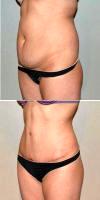 35 Year Old Woman Treated With Tummy Tuck By Doctor George Marosan, MD, Bellevue Plastic Surgeon