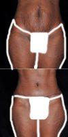 35 Year Old Woman Treated With Tummy Tuck By Doctor Scott W. Harris, MD, FACS, Dallas Plastic Surgeon