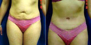 35 Year Old Woman Treated With Tummy Tuck By Dr Vincent D. Lepore, MD, San Jose Plastic Surgeon