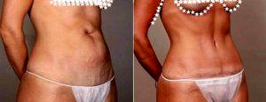 35 Year Old Woman Treated With Tummy Tuck By Dr. Scott Chapin, MD, FACS, Philadelphia Plastic Surgeon