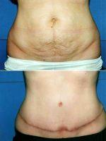 35 Year Old Woman With Lax Abdominal Wall Post Pregnancy By Dr. Dean E. Sorensen, MD, Boise Plastic Surgeon