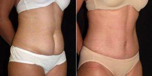 36 Year Old Woman Treated With Tummy Tuck And Liposuction By Dr. Bao L. Phan, MD, Honolulu Plastic Surgeon