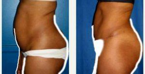 36 Year Old Woman Treated With Tummy Tuck And Liposuction Of The Flanks. With Doctor Camille Cash, MD, Houston Plastic Surgeon