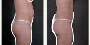 36 Year Old Woman Treated With Tummy Tuck And Liposuction With Dr. Richard J. Bruneteau, MD, Omaha Plastic Surgeon