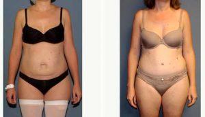 36 Year Old Woman Treated With Tummy Tuck By Doctor Adam Tattelbaum, MD, Washington DC Plastic Surgeon