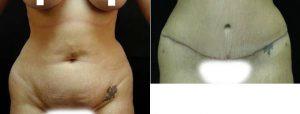 36 Year Old Woman Treated With Tummy Tuck By Dr. Leonard Tachmes, MD - , Miami Plastic Surgeon