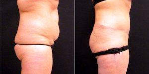 36 Year Old Woman Treated With Tummy Tuck With SAFELipo Of Flanks And Back Rolls By Doctor Stephen E. Zucker, MD, South Bend Plastic Surgeon