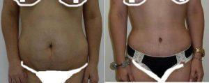 36 Yo Female Tummy Tuck With Flank Liposuction By Doctor Rami Ghurani, MD, Miami Plastic Surgeon