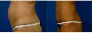 37 Year Old Woman Treated With Tummy Tuck By Dr John McFate, MD, Austin Plastic Surgeon