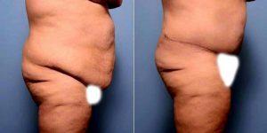 37 Year Old Woman Treated With Tummy Tuck By Dr. Barry L. Eppley, MD, DMD, Indianapolis Plastic Surgeon