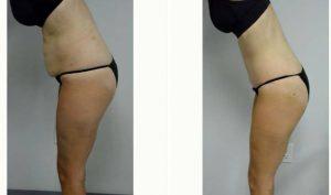 38 Year Old Woman Treated With Tummy Tuck And Liposuction Of Her Flanks And Lower Back By Dr. Jonathan Hall, MD, Boston Plastic Surgeon