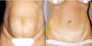 38 Year Old Woman Treated With Tummy Tuck By Dr Laurence Kirwan, MD, FRCS, FACS, Norwalk Plastic Surgeon