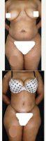 38 Year Old Woman Treated With Tummy Tuck - Liposuction To Abdomen, Flanks And Back By Dr. Luis Eduardo Redondo, MD, Dominican Republic Plastic Surgeon