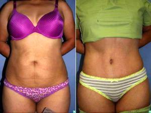39 Year Old Female Abdominoplasty And Flank Liposuction By Dr Christopher T. Maloney Jr., MD, Tucson Plastic Surgeon