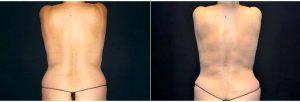 39 Year Old Woman Treated With Tummy Tuck And Circumferential Liposuction By Dr Landon Pryor, MD, FACS, Rockford Plastic Surgeon