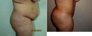 39 Year Old Woman Treated With Tummy Tuck By Dr Carlos Lopez Collado, MD, Dominican Republic Plastic Surgeon